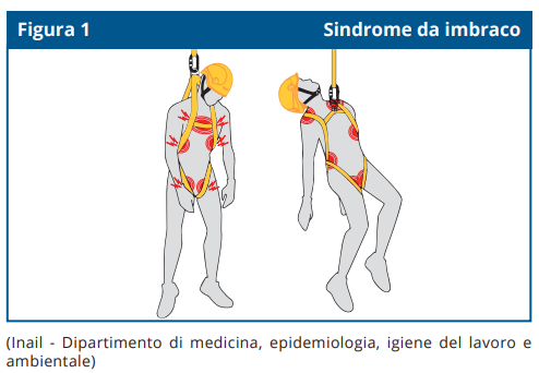 Sindrome da imbraco Sindrome da imbraco